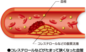 血管の硬化画像